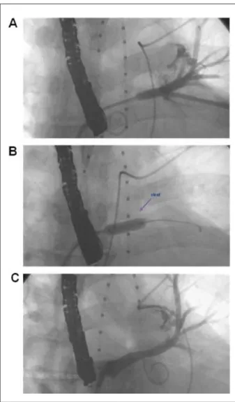 Figure 2 - A - Retrograde angiography of the LSPV showing severe stenosis  at  its  ostium;  B  -  Stenting  (Express  LD  7.0  x  17  mm)  of  the  LSPV  ostium; 