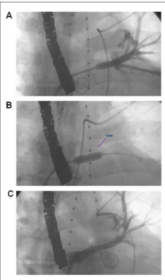 Fig. 2 - A - Angiografía retrógrada de la VPSI revelando estenosis acentuada  del ostio de la VPSI