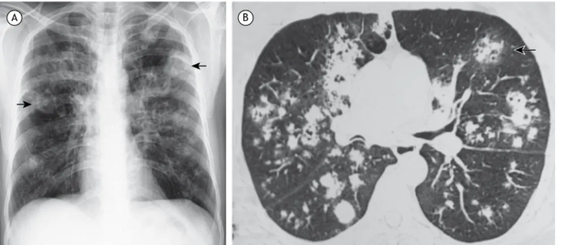 Figura 1.  A) Radiografia de tórax, realizada após o início dos sintomas, mostrando consolidações multifocais bilaterais  com cavitação em algumas das lesões (setas); B) TCAR de tórax, realizada uma semana após o início dos sintomas,  mostrando múltiplas á