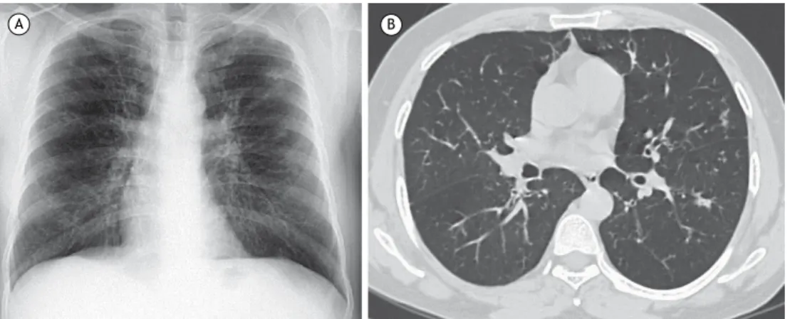 Figura 2.  Radiografia de tórax (A) e TCAR de tórax (B), ambas realizadas após dois meses de tratamento, mostrando  resolução importante das lesões, com fibrose residual.