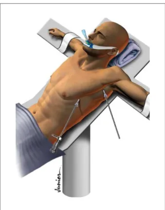 Figure 1 - Schematic representation of patient positioning and pleural incisions  for thoracoscopic sympathetic blockade.