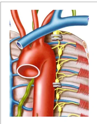 Figure 2 - Schematic representation of double clipping of the stellate ganglion  and T3-T4 interspinal space.