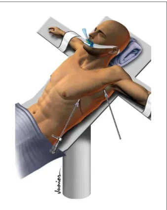 Figura 1 - Representación esquemática del posicionamiento del paciente y de  las incisiones pleurales para el bloqueo simpático por toracoscopia.