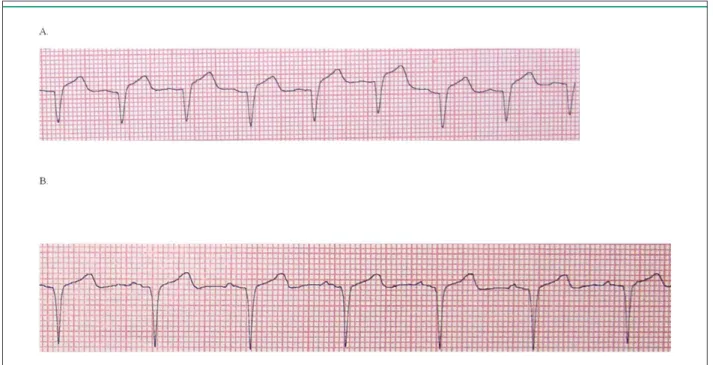 Figure 1 - Shortening of QRS duration on the surface electrocardiogram, A: 102 ms before levosimendan administration B: 93 ms after levosimendan administration.