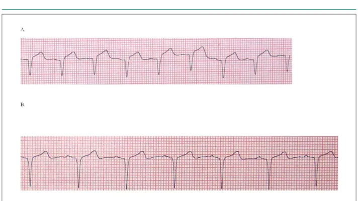Figura 1 - Acortamiento de la duración del QRS en el electrocardiograma de supericie, A: 102 ms antes de la administración de levosimendan;  B: 93 ms después de  la administración de levosimendan.