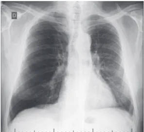 Figura 1.  Radiografia de tórax de paciente submetido a  transplante unilateral esquerdo por DPOC.
