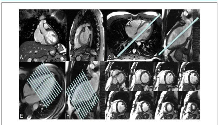 Figure 1 - The beginning of the exam. Localizing sequences of CMR, according to thorax planes
