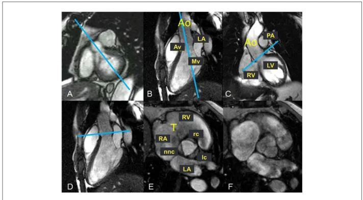 Figure 4 - Study of the aortic valve. (A) Basal short axis with the LV outlow tract and planning of the three-chamber or outlow tract plane