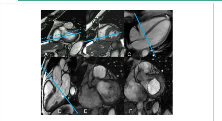 Figure 5 -  Study of the mitral valve. (A) Basal short axis with the LV outlow tract. Dotted line, wrong plane for planning the true four-chamber plane