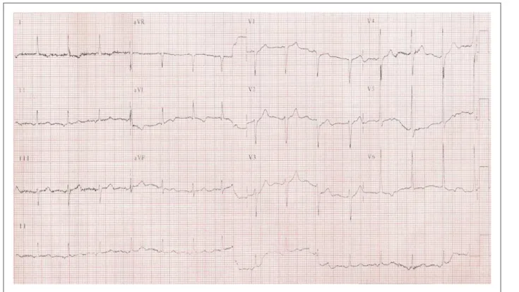 Figure 2 - ECG: sinus rhythm, frequency of 88 beats per minute and subtle changes in ventricular repolarization.
