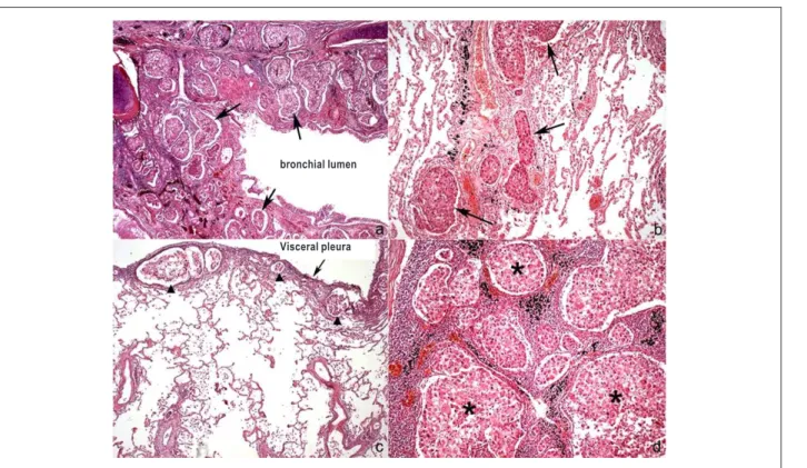Figure 5 - Histology of the lung (a, b and c) and lymph node of lung hilum (d). a) Cross section of bronchus showing a number of carcinoma emboli in lymphatic vessels  on its wall (some indicated by arrows)
