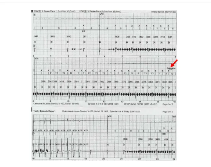 Figure 1 - ATP therapy hindered by noise. The lower tracing shows high-frequency artifacts