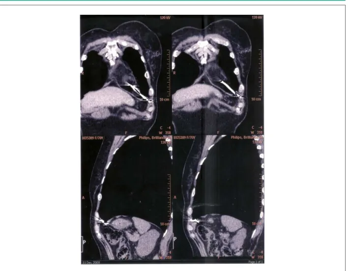 Figure 2 - Chest CT. Note the electrode tip perforating the RV and located in the costal grid.