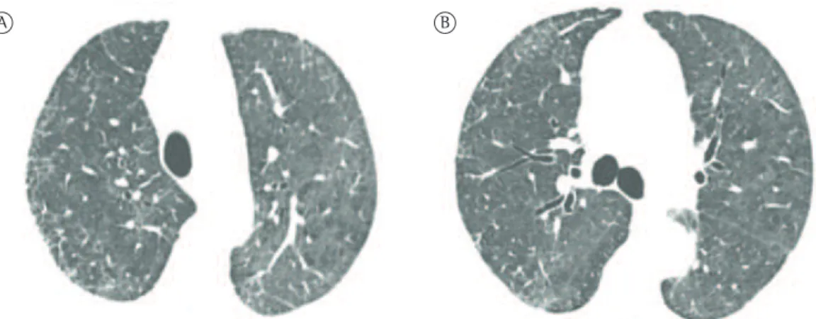 Figura 2 - TCAR de tórax realizada três semanas após o início do quadro. A análise comparativa dos cortes  mostra melhora importante e espontânea das opacidades em vidro fosco com relação ao exame anterior nos  campos pulmonares superiores, em A, e no níve