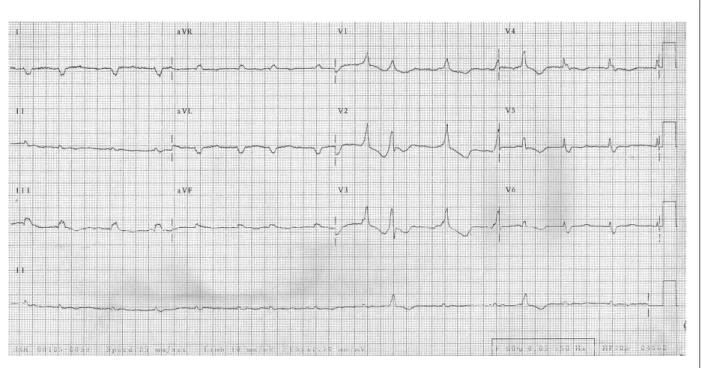 Fig. 2 -  (ECG): ibrilação atrial, baixa voltagem plano frontal, QRS alargado, R puros me V 1  e V 2 .