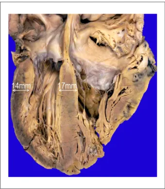 Fig. 5 -  Corte do coração do tipo quatro câmaras: hipertroia simétrica dos  ventrículos  esquerdo  e  direito,  sem  obstrução  cavitária