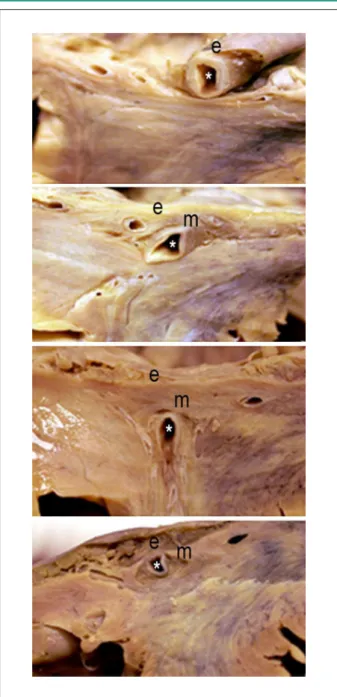 Fig. 7 - Cortes transversais dos ventrículos: trajeto intramiocárdico do ramo  interventricular anterior da artéria coronária esquerda (e - endocárdio; m -  miocárdio; * - luz coronária).