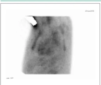 Figure 4 - Technetium pyrophosphate scan, left anterior oblique view at 60°: 