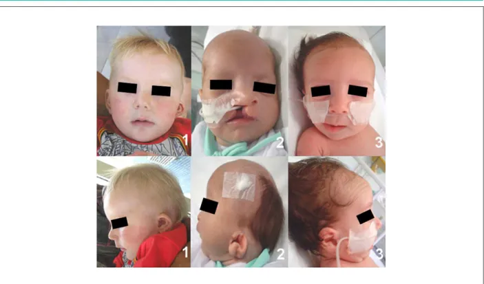 Figure 1 - Front and lateral view of the patients with oculo-auriculo-vertebral spectrum (OAVS): patient 1 at 11 months of age (pulmonary atresia associated to ventricular  septal defect), patient 2 at 2 months of age (cor triatriatum) and patient 3 at 2 m
