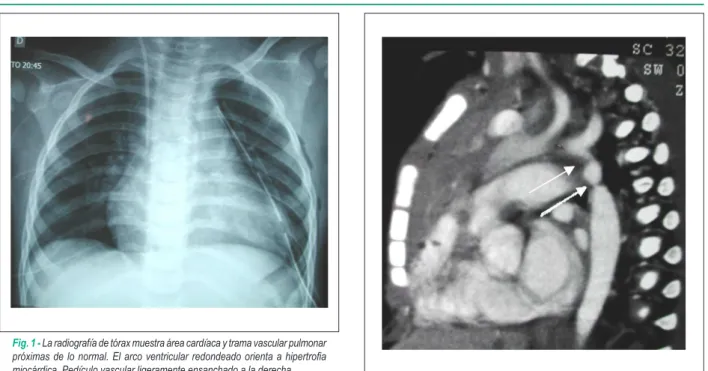 Fig. 2 - La resonancia magnética muestra la coartación de la aorta ístmica,  después  de  la  emergencia  de  la  arteria  subclavia  izquierda  con  dos  estrechamientos contiguos (lechas)