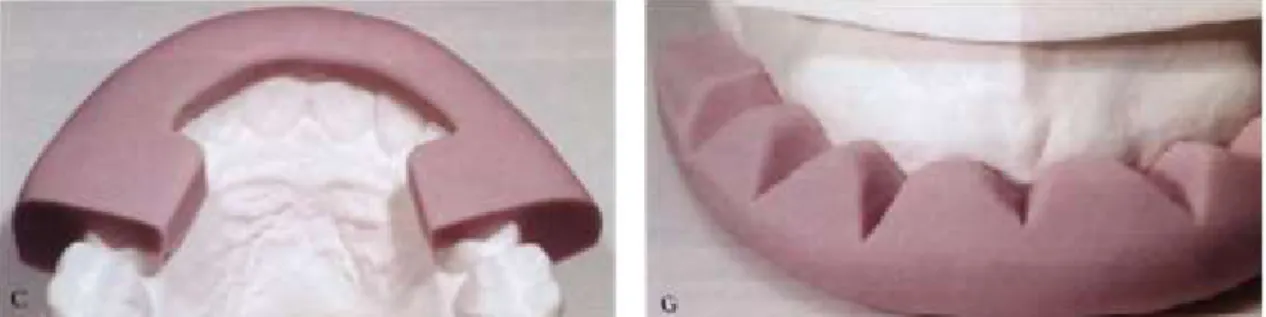 Figura 5. Confecção da chave de silicone sobre o modelo de estudo (Adaptado de Magne &amp; Belser,  2004)