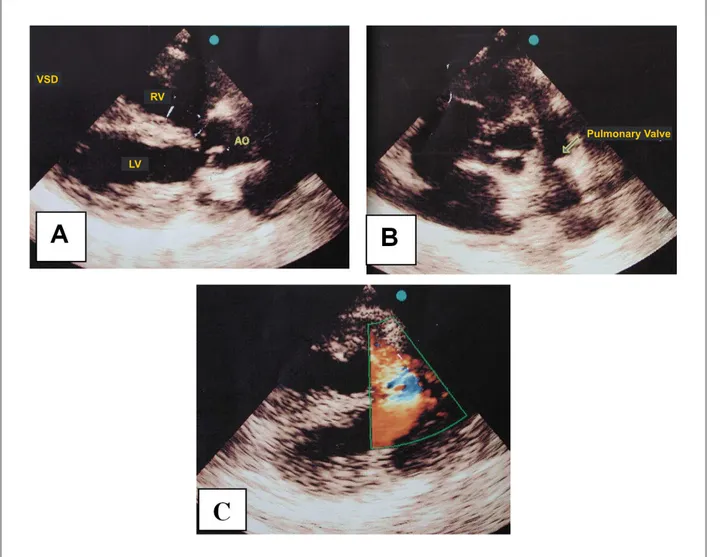 Figure 2 - Echocardiogram showing signs of tetralogy of Fallot with the aorta riding over the interventricular septum and subaortic VSD (A); narrow pulmonary annulus  and dilatation of the main and central pulmonary arteries (B); and pulmonary valve stenos