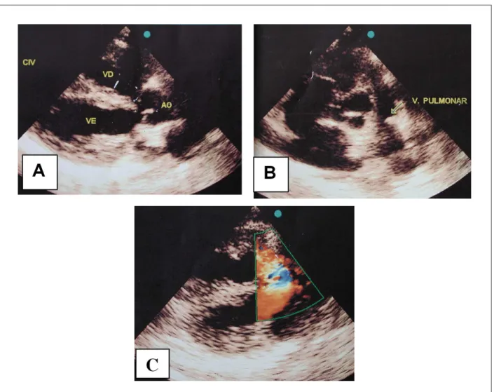 Fig. 2 - El ecocardiograma destaca las señales de la tetralogía de Fallot con cabalgamiento de la aorta en el septo interventricular y la CIV subaórtica, en A, anillo  pulmonar estrecho y dilatación del tronco y de las arterias pulmonares centrales, en B, 