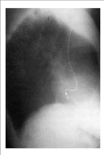 Figure  2  - Proile chest X-ray shows the posterior path of the pacemaker  electrode.