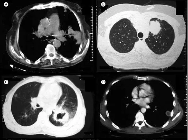 Figura 1 - Cortes de TC helicoidal mostrando contornos de massa pulmonar irregular (em A; paciente 