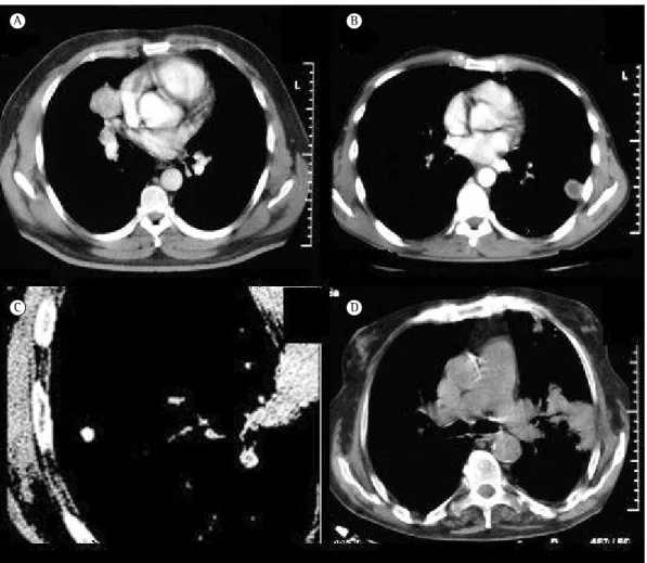 Figura 2 - Cortes de TC helicoidal mostrando alterações intralesionais com aspecto homogêneo (em A; 