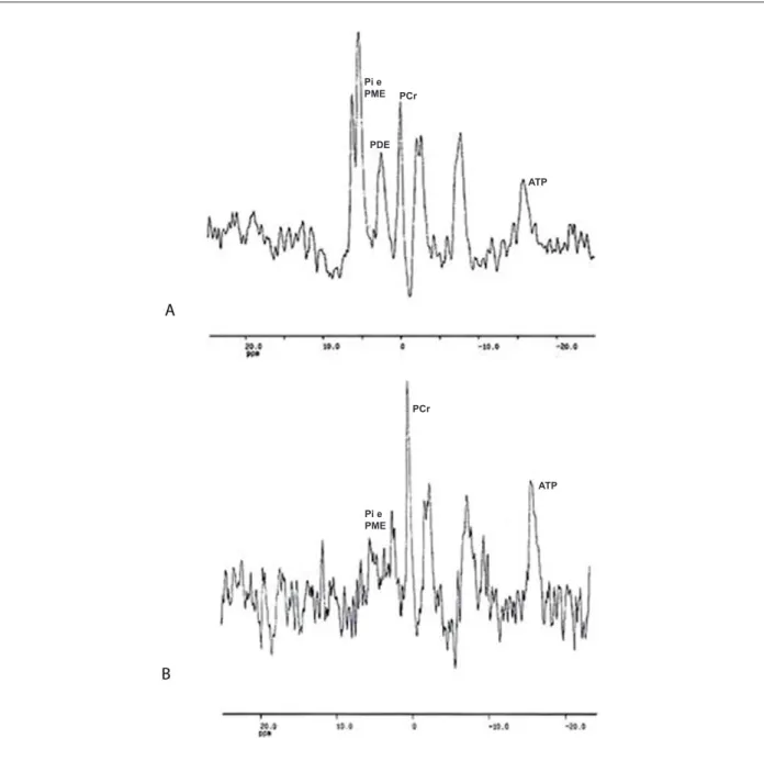 Figure 1 - (A) Phosphorus-31 spectrum of a patient from the ventricular dysfunction group