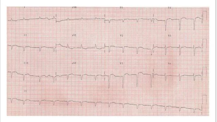 Fig. 1 - ECG: Eixo QRS deslocado para esquerda e para cima (BDAS) e baixa voltagem do complexo QRS no plano frontal e área eletricamente inativa parede anterior.