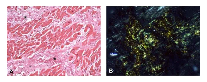 Fig. 4 - Amiloidose cardíaca. Deposição de material eosinofílico e amorfo (asteriscos) no interstício do miocárdio (A), apresentando nítida coloração esverdeada quando  corado pelo Vermelho do Congo e visto sob luz polarizada (B)