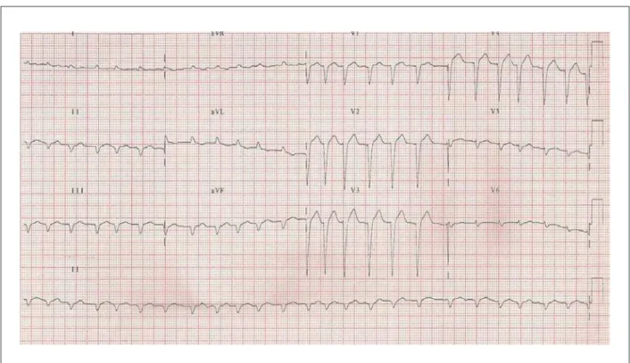 Figure 2 - ECG: Atrial ibrillation, low voltage in the frontal area and electrically inactive area in the anterior wall.