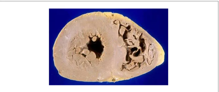 Figure 3 - Cross-section of heart ventricles. Observe the thickened walls and slightly yellowish color of the myocardium.