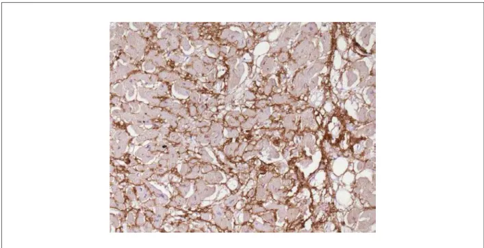 Figure 5 - Strongly positive immunohistochemical reaction for immunoglobulin lambda chain in the heart interstitium (dark-brown color), corresponding to the areas of  amyloid substance deposition