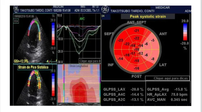 Figure 1 -  To the left, analysis of systolic function by the two-dimensional strain method in the LV segments assessed (two-chamber apical section), where we observe  a signiicant reduction in peak systolic strain in anterior and lateral LV segments (red,