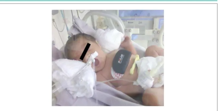 Fig. 1 - Fijación del captador del Polar S810i en neonato prematuro con auxilio de electrodos comunes de monitoreo cardíaco.