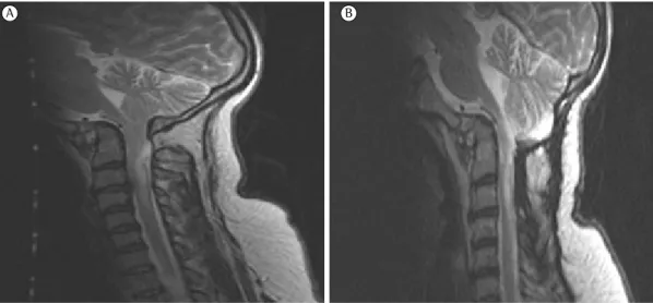 Figura 1 - Em A, imagem de ressonância magnética cerebral pré-cirurgia demonstrando malformação óssea 