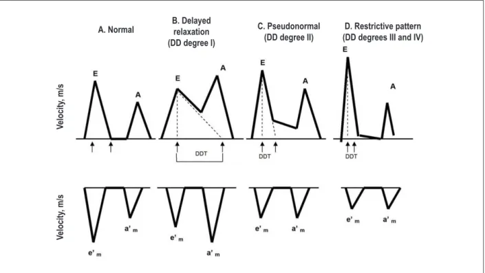 Figure 3 - Evaluation of different degrees of diastolic dysfunction using data obtained from the transmitral low pattern (top) and analysis of tissue Doppler at the mitral  annulus level (bottom)