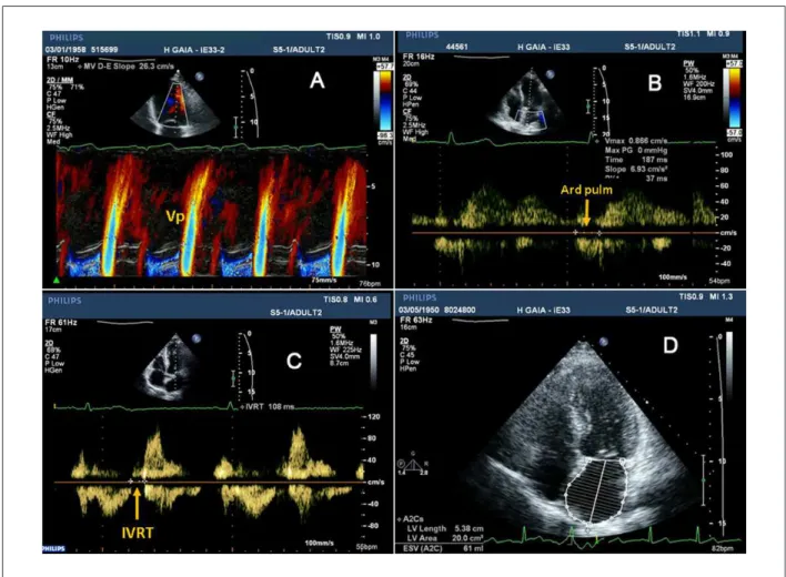 Figure 5 - Demonstration of different echocardiographic parameters used for diastolic dysfunction analysis