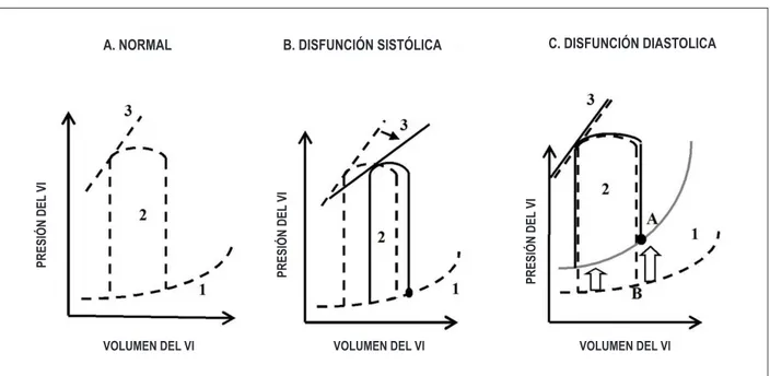 Fig. 1 - Aumento y relaciones presión-volumen (P-V) ventriculares izquierdas en la disfunción sistólica y diastólica