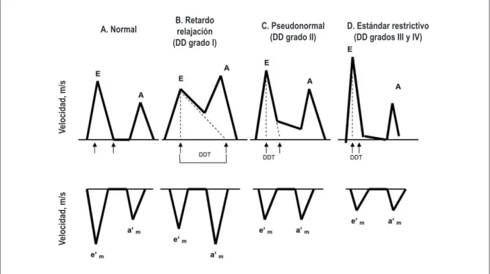 Fig. 3 - Evaluación de los diferentes grados de disfunción diastólica utilizando los datos obtenidos del estándar de lujo transmitral (arriba) y del análisis del Doppler  tisular a nivel del anillo mitral (abajo)