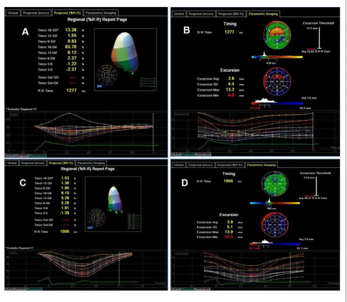 Figure 2 - (A) Dyssynchrony index on 3D Echo (T msv%). Volumetric variation curves are presented for each of the 16 left ventricular segments