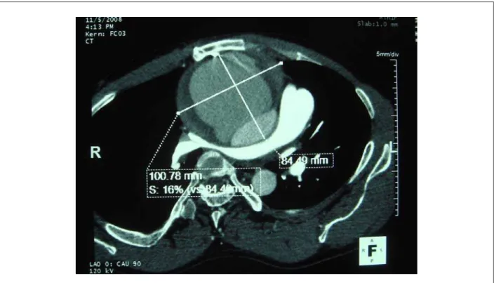 Fig. 2 - Ponto de ruptura. Devem-se observar o extravasamento do contraste da luz verdadeira à luz falsa do aneurisma e a importante compressão de artéria pulmonar  direita, com diâmetro residual de medido de 2,28 mm.