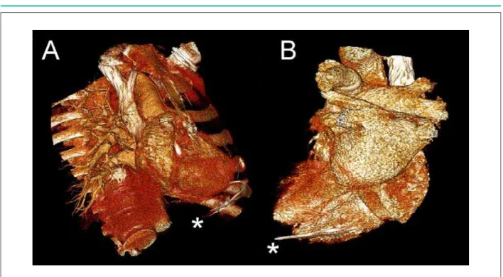Figure 2 - Chest computed tomography (volume-rendering technique) demonstrating reconstruction of the right ventricular lead perforation (A and B)