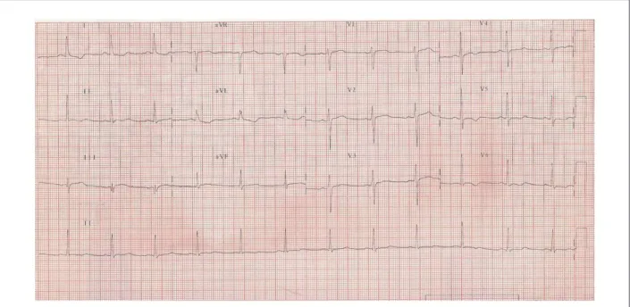Figure 1 - ECG. Sinus rhythm and mild abnormalities in ventricular repolarization.