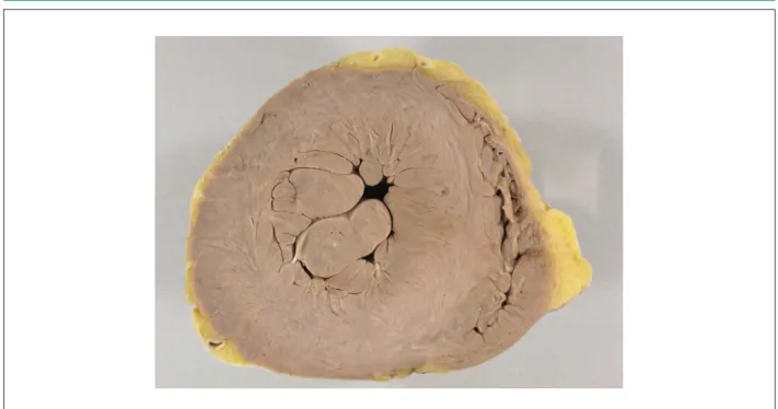 Figure 4 - Cross section of the cardiac ventricles. Marked left ventricular concentric hypertrophy, characterized by increased wall thickness and decreased cavity.