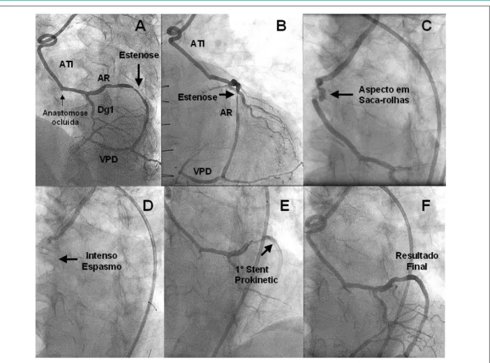 Fig. 1 -  A e B - Coronariograia em oblíqua anterior esquerda e direita, demonstrando a estenose no enxerto da artéria radial e a anastomose para ADA ocluída (setas)