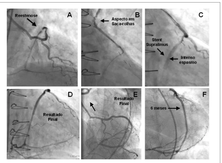 Fig. 2 -  - A e B - Coronariograia em oblíqua anterior esquerda e direita, demonstrando a reestenose no enxerto da artéria radial (setas)